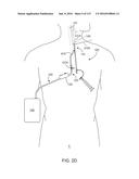 Systems And Methods For Treating A Carotid Artery diagram and image