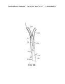 Systems And Methods For Treating A Carotid Artery diagram and image