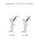 Systems And Methods For Treating A Carotid Artery diagram and image