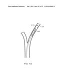 Systems And Methods For Treating A Carotid Artery diagram and image