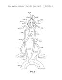 Systems And Methods For Treating A Carotid Artery diagram and image