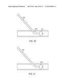 Systems And Methods For Treating A Carotid Artery diagram and image