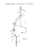 Systems And Methods For Treating A Carotid Artery diagram and image