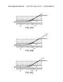 Systems And Methods For Treating A Carotid Artery diagram and image