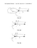 Systems And Methods For Treating A Carotid Artery diagram and image