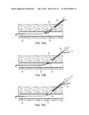 Systems And Methods For Treating A Carotid Artery diagram and image