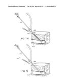 Systems And Methods For Treating A Carotid Artery diagram and image