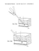 Systems And Methods For Treating A Carotid Artery diagram and image