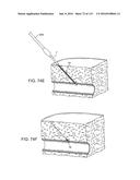 Systems And Methods For Treating A Carotid Artery diagram and image