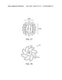 Systems And Methods For Treating A Carotid Artery diagram and image