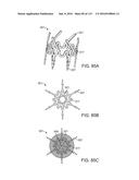 Systems And Methods For Treating A Carotid Artery diagram and image