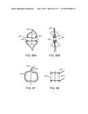 Systems And Methods For Treating A Carotid Artery diagram and image