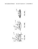 Systems And Methods For Treating A Carotid Artery diagram and image