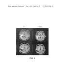USE OF DIANHYDROGALACTITOL AND ANALOGS AND DERIVATIVES THEREOF TO TREAT     RECURRENT MALIGNANT GLIOMA OR PROGRESSIVE SECONDARY BRAIN TUMOR diagram and image