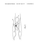 DIALYSIS VALVE AND METHOD diagram and image