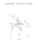 Methods and Apparatus for Administering Local Anesthetic diagram and image