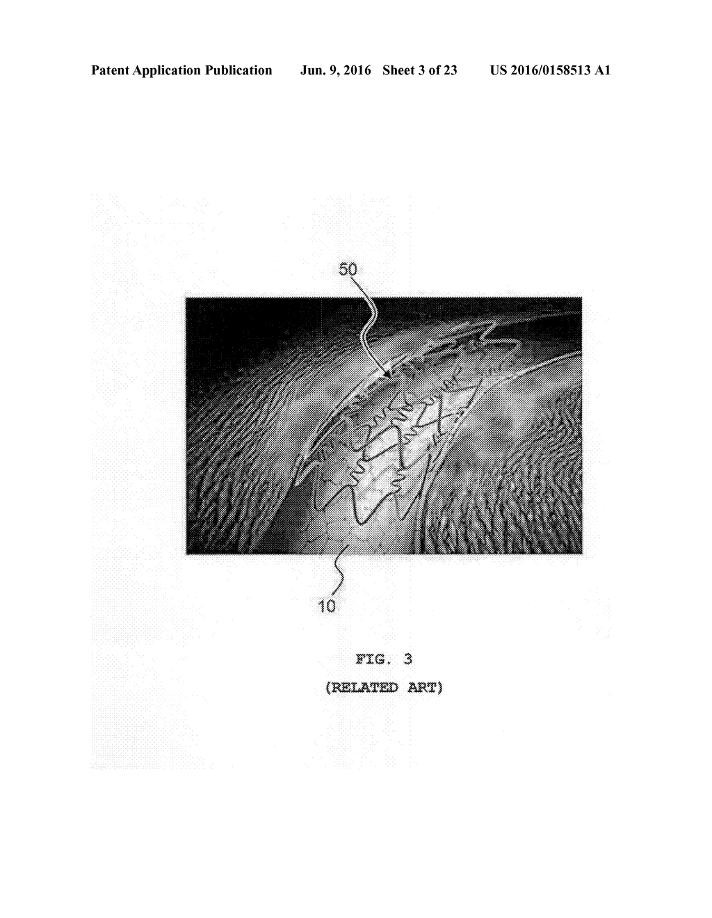 BALLOON CATHETER HAVING MICRO NEEDLES AND MANUFACTURING METHOD FOR THE     SAME - diagram, schematic, and image 04