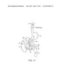 THERAPEUTIC AGENT PREPARATIONS FOR DELIVERY INTO A LUMEN OF THE INTESTINAL     TRACT USING A SWALLOWABLE DRUG DELIVERY DEVICE diagram and image