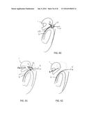 HEAD AND NECK RESTRAINT DEVICE WITH DYNAMIC ARTICULATION diagram and image