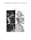 PERSONALIZED PROTEASE ASSAY TO MEASURE PROTEASE ACTIVITY IN NEOPLASMS diagram and image