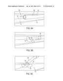 Implantable Sealable Member with Mesh Layer diagram and image