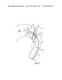 METHODS AND SYSTEMS FOR PREVENTING BLEEDING FROM THE LEFT ATRIAL APPENDAGE diagram and image