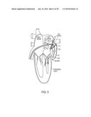 METHODS AND SYSTEMS FOR PREVENTING BLEEDING FROM THE LEFT ATRIAL APPENDAGE diagram and image