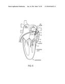 METHODS AND SYSTEMS FOR PREVENTING BLEEDING FROM THE LEFT ATRIAL APPENDAGE diagram and image