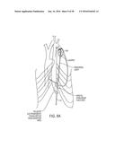 METHODS AND SYSTEMS FOR PREVENTING BLEEDING FROM THE LEFT ATRIAL APPENDAGE diagram and image