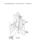 METHODS AND SYSTEMS FOR PREVENTING BLEEDING FROM THE LEFT ATRIAL APPENDAGE diagram and image