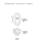 METHODS AND SYSTEMS FOR PREVENTING BLEEDING FROM THE LEFT ATRIAL APPENDAGE diagram and image