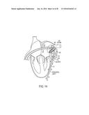 METHODS AND SYSTEMS FOR PREVENTING BLEEDING FROM THE LEFT ATRIAL APPENDAGE diagram and image