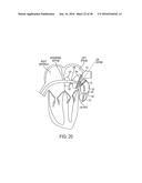 METHODS AND SYSTEMS FOR PREVENTING BLEEDING FROM THE LEFT ATRIAL APPENDAGE diagram and image