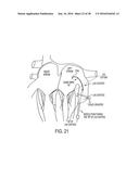 METHODS AND SYSTEMS FOR PREVENTING BLEEDING FROM THE LEFT ATRIAL APPENDAGE diagram and image