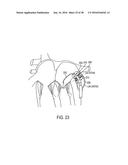 METHODS AND SYSTEMS FOR PREVENTING BLEEDING FROM THE LEFT ATRIAL APPENDAGE diagram and image