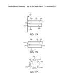 METHODS AND SYSTEMS FOR PREVENTING BLEEDING FROM THE LEFT ATRIAL APPENDAGE diagram and image