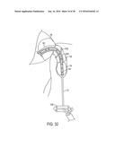 METHODS AND SYSTEMS FOR PREVENTING BLEEDING FROM THE LEFT ATRIAL APPENDAGE diagram and image