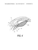 SUPERCAVITATING MEDICAL PROBE AND METHOD OF USE diagram and image