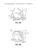 SCLERAL PROSTHESIS FOR TREATING PRESBYOPIA AND OTHER EYE DISORDERS AND     RELATED DEVICES AND METHODS diagram and image