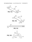 SCLERAL PROSTHESIS FOR TREATING PRESBYOPIA AND OTHER EYE DISORDERS AND     RELATED DEVICES AND METHODS diagram and image