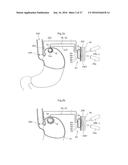 DEVICE FOR TREATING OBESITY diagram and image