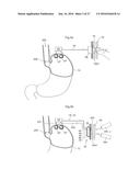 DEVICE FOR TREATING OBESITY diagram and image