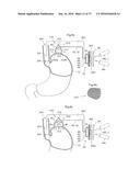 DEVICE FOR TREATING OBESITY diagram and image