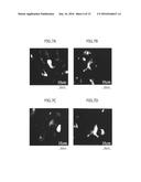 Material for Treatment of Cerebral Infarction diagram and image