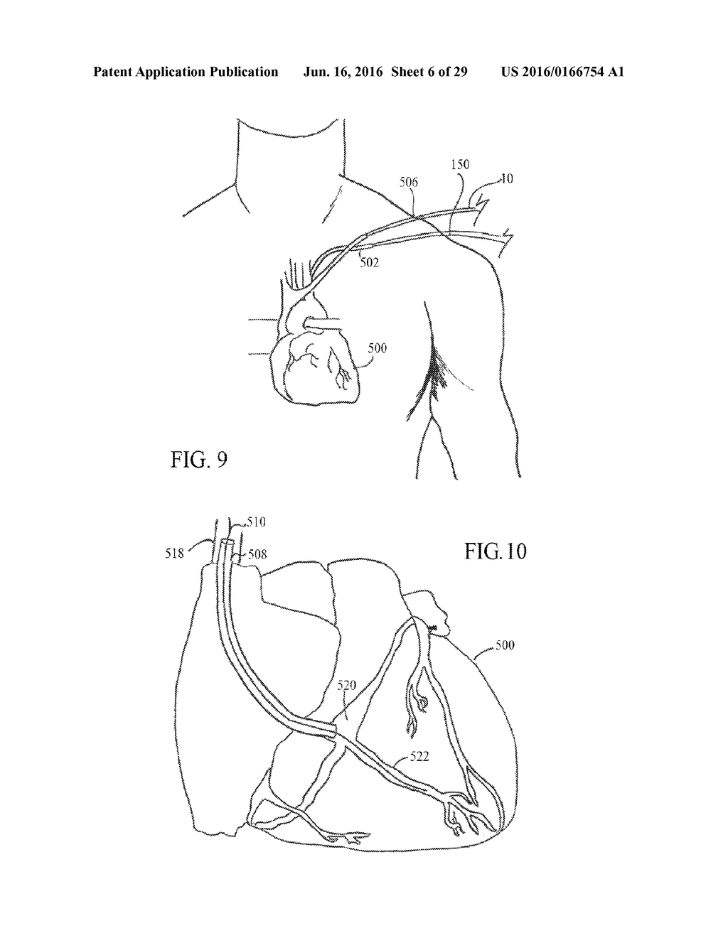 UNITARY BODY SYSTEMS AND DEVICES AND METHODS TO USE THE SAME FOR     RETROPERFUSION - diagram, schematic, and image 07