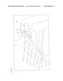 METHODS FOR TREATING SINUS OSTIA USING BALLOON CATHETER DEVICES HAVING A     BENDABLE BALLOON PORTION diagram and image