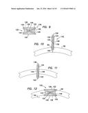 Wound Retractor diagram and image