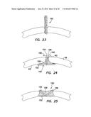 Wound Retractor diagram and image