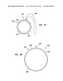 Wound Retractor diagram and image