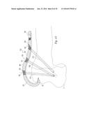 Bone Plate diagram and image